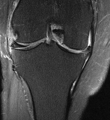Figure 5 for case chondrocalcinosis within chronic unstable medial meniscus flap tear and adjacent tibial remodeling ( RID5398 )